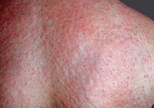 Back rash treating with Chinese Medicine Shen Di Foxglove Vancouver at BodaHealth