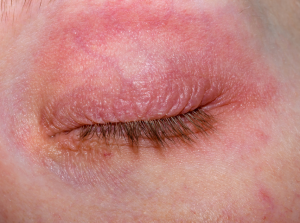 eye rash condition wih Foxglove treatment and Chinese Medicine