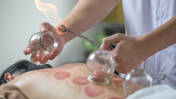 cupping treatment for sports injuries at Bodahealth in Vancouver