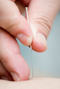 holding an acupuncture needle in Vancouver treating sports injuries