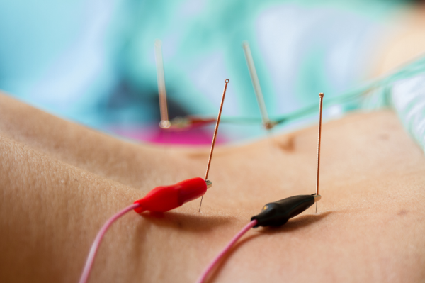 electrodes acupuncture in vancouver to treat muscle injuries